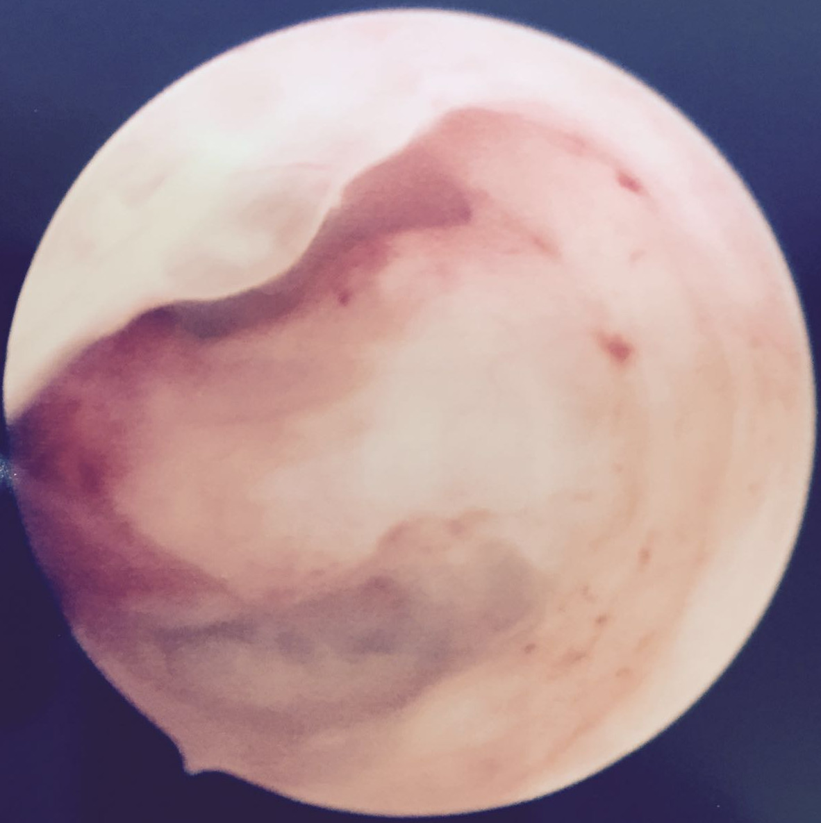 Iperplasia Semplice Polipoide Dell Endometrio
